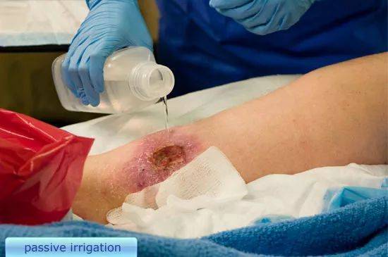 伤口清洗流程