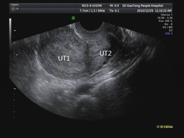 超声:残角子宫及残角子宫妊娠