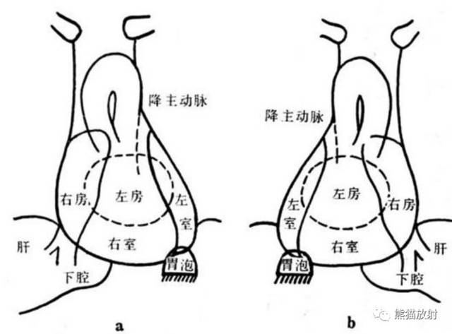 心脏及大血管位置异常丨相关概念及表现