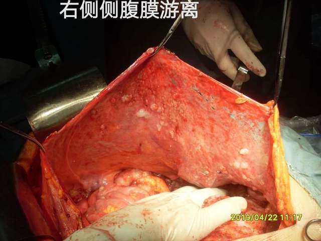 大网膜成饼与腹膜无粘连,左侧卵巢囊肿直径15cm,包膜破裂,有果冻样