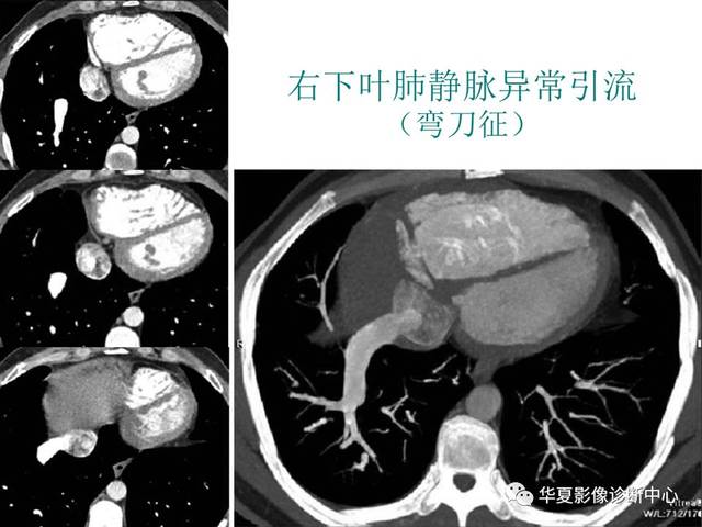 肺静脉异位引流