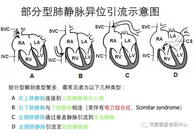 肺静脉异位引流图片