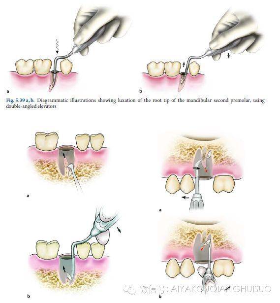 拔牙收牙缝过程图图片