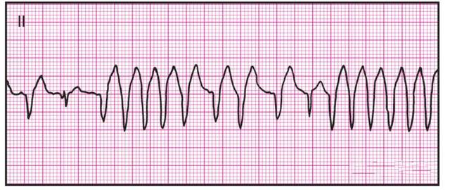 14种异常心电图的波形特点,建议收藏!