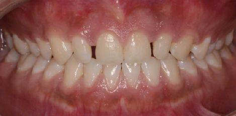 多学科联合治疗上侧切牙畸形过小牙一例——孙丽艳医师