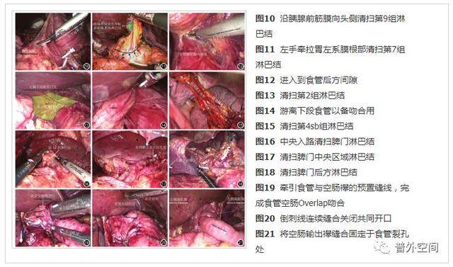 單孔及減孔腹腔鏡胃癌根治術的技術難點解析