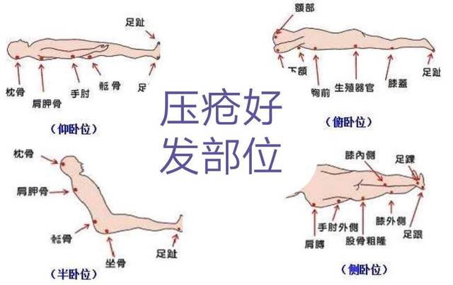 預防壓瘡護理的健康指導