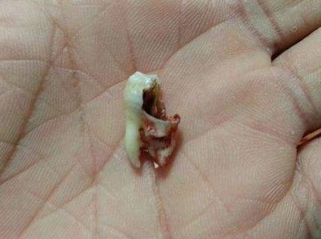 牙齿里面的蛀虫图片图片
