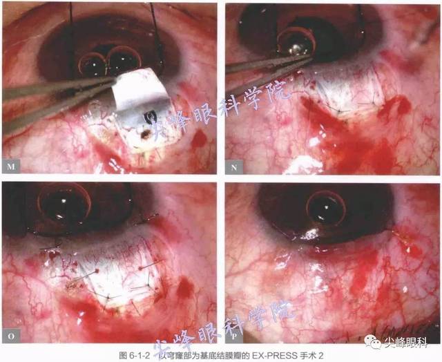 ex-press青光眼微型引流器植入手术 part01《图解青光眼手术操作与