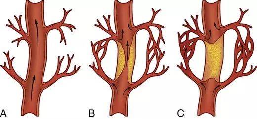 老年人冠脉长期狭窄,其他血管会形成侧支循环给心肌供血,就算急性心肌