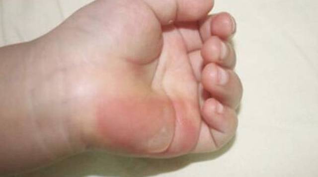 孩子烫伤怎么办?最佳处理时间只有2分钟,家长们赶紧看看吧