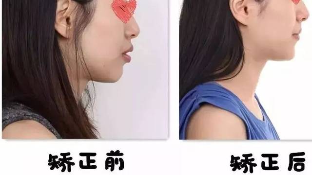 8个真实案例 | 牙齿矫正,拯救你的"没下巴"!