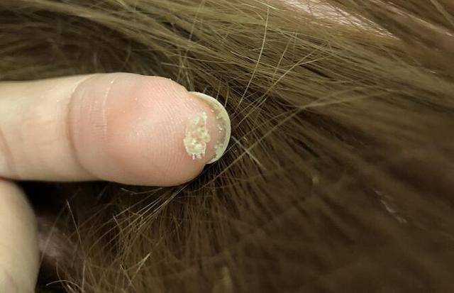 头上螨虫如果严重超标,这5个迹象会很明显,教你2招螨虫全死光