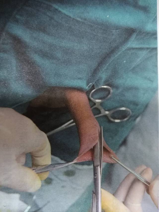 韩式微雕包茎手术图片