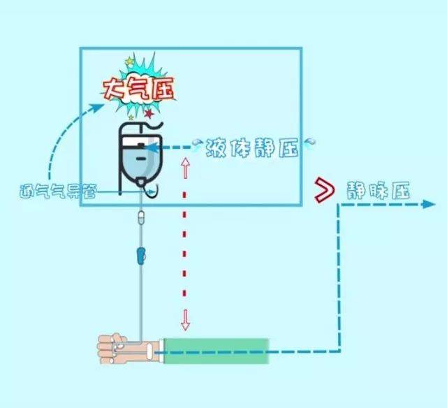 静脉输液排气方法图图片