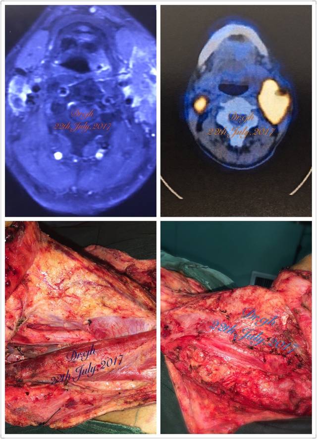 下咽癌诊治体会 (原创)