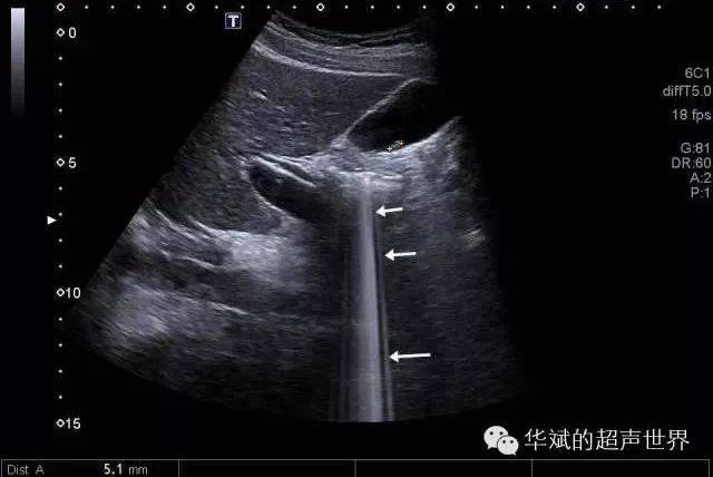 超声伪像:彗星尾征和振铃伪像