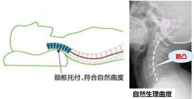 颈椎生理曲度变直骨科医生教你几招