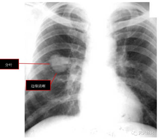 答案就鎖定在了肺結核(結核球),肺癌(原發性肺癌)中,單純這個胸片是