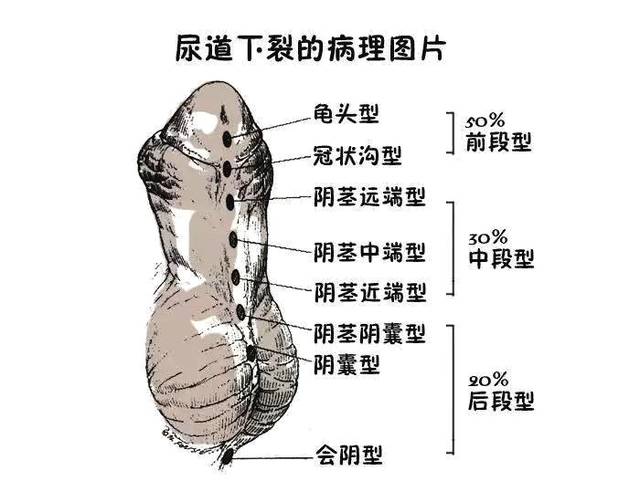 尿道下裂分型图片