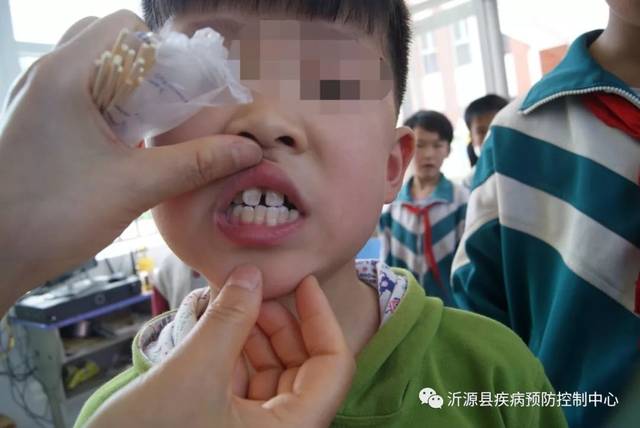 沂源县开展饮水型地方性氟中毒监测工作