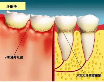 什么是青春期龈炎