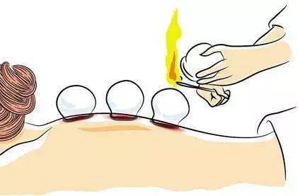 拔完火罐后,为什么印记颜色会不同?