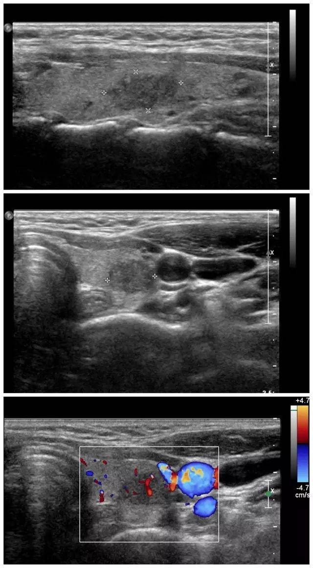 【超声微课堂】甲状腺乳头状癌经典型