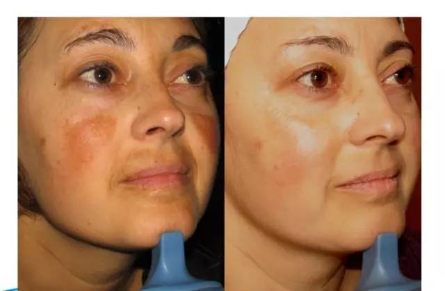 黄褐斑,老年斑,黑斑傻傻分不清?看这里!