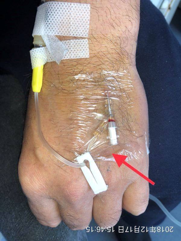 留置针固定的这个细节,你确定做规范了吗?_手机搜狐网