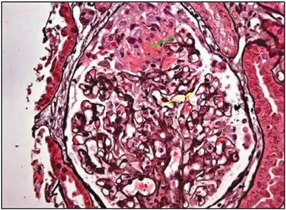 肾内病理图解 | 膜性肾病