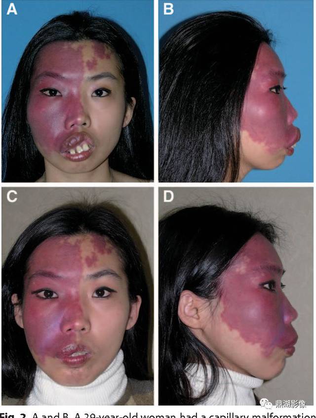 超典型病例颅面血管瘤病sturgeweber综合征
