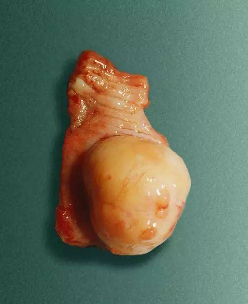 14厘米脂肪瘤在食管安营扎寨 6小时内镜手术剥离技术超赞