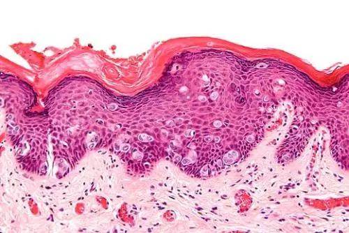 怎样治疗乳腺paget病?_手机搜狐网