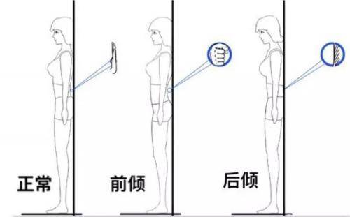 什么是骨盆前倾?怎么改善下交叉综合症?