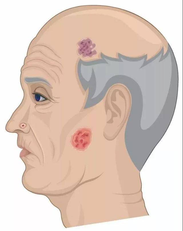 面部长痦子命运图解图片