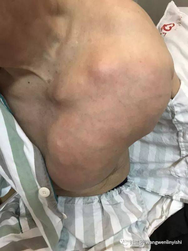 50年巨大胸壁肿瘤今天被切除