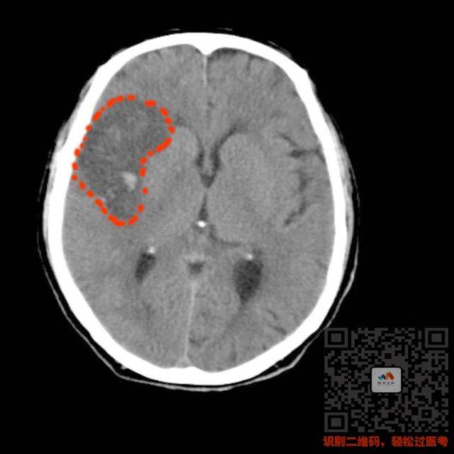执医技能—ct阅片速成,让你秒懂!