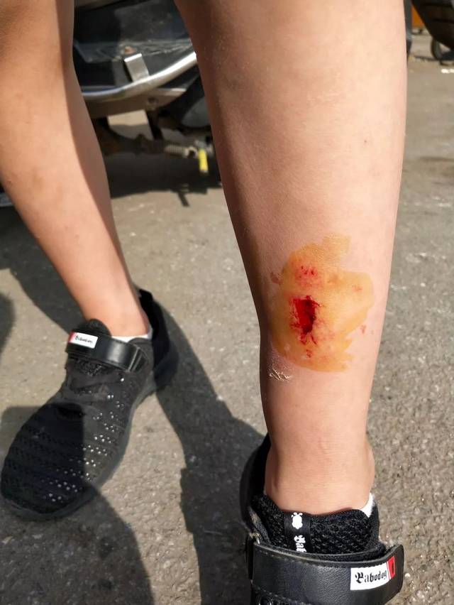 腿被电瓶车撞肿的图片图片