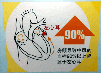 左心耳封堵——让"抖动的心"平静下来.