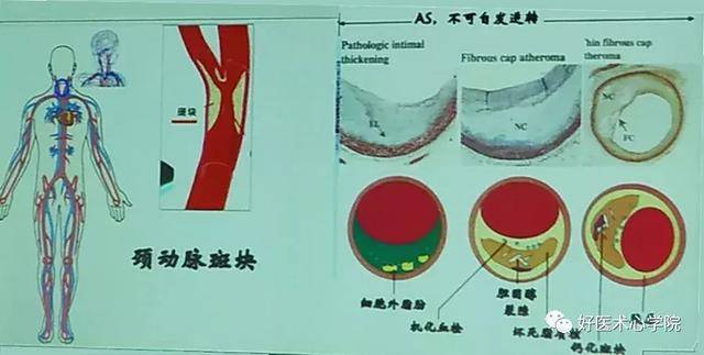 颈动脉有斑块,治还是不治?