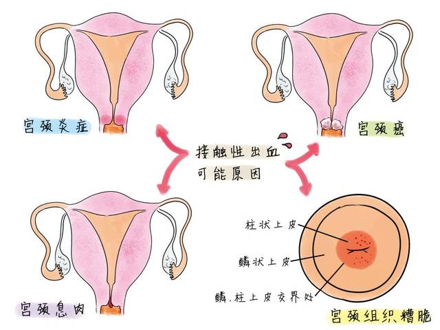 同房后出血,警惕疾病找上门