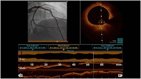 考虑存在冠脉痉挛因素,下一步进行oct检查(图13,视频2),发现前降支近