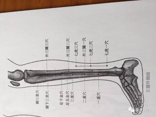 董氏针灸林正泰案例分享之侧三里侧下三里穴