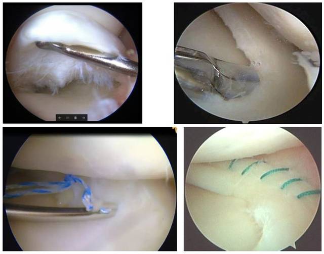 入院后完善左膝关节mri及 ct三维重建及其他术前相关检查.