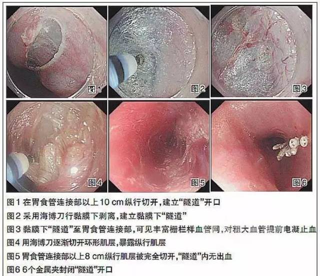 贲门失迟缓症患者的福音:运城市第一医院消化内科成功开展poem手术