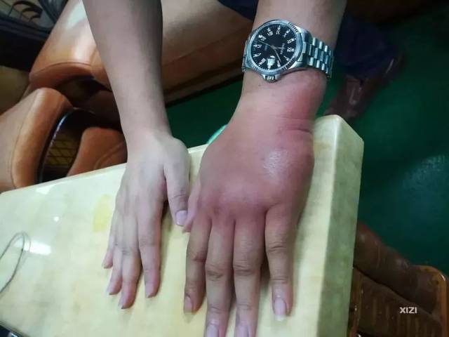 惠州小伙被蚂蚁咬了后,整只手肿成"猪蹄"!