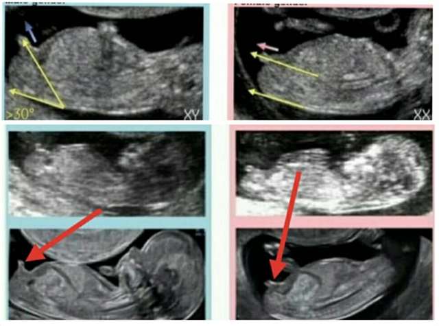 孕12周胎儿性别发育图图片