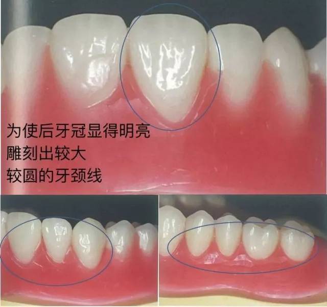 1,检查排牙与咬合,确认排牙结果 2,固定上下颌蜡型于模型 3,按解剖