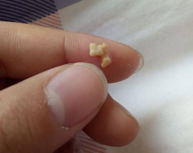 牙齿上抠出的"黄色块状物"其实是这种东西!时间越长越洗不干净